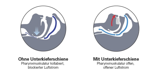 oral-appliance-upper-airway-mechanism-resmed