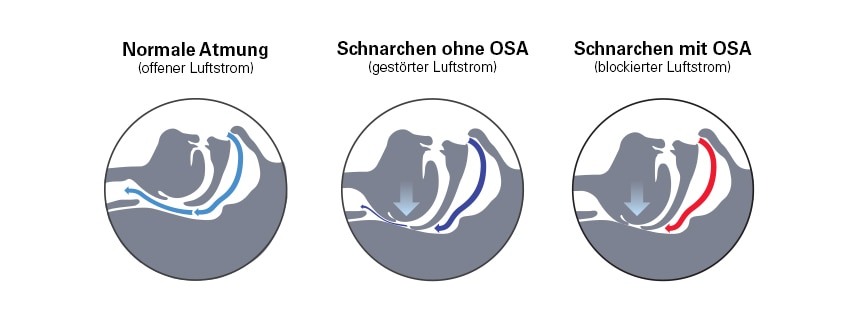 the-airway-when-you-snore-apnoea