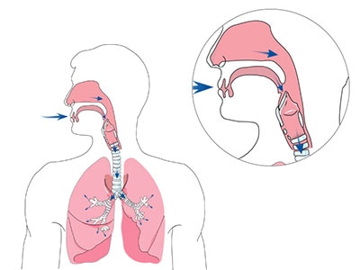 home-noninvasive-ventilation-breathing-respiration-400x300